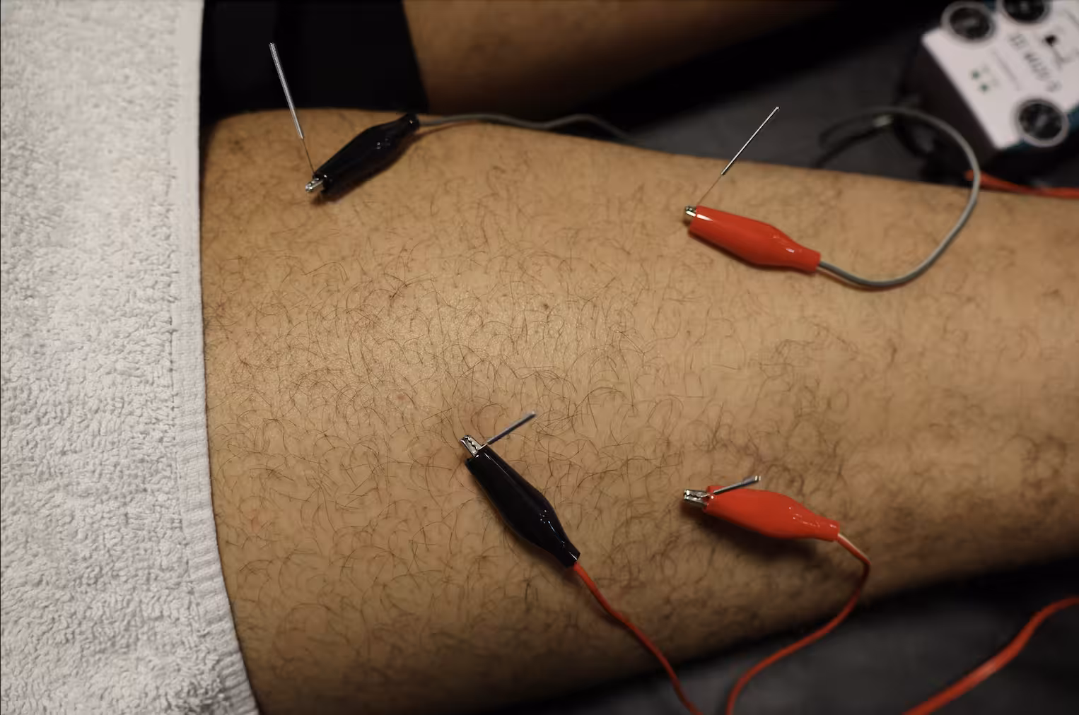 Functional Dry Needling